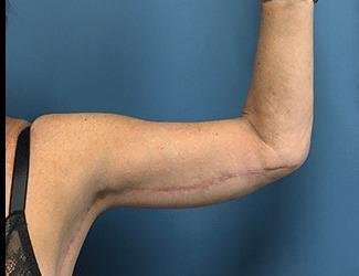 Arm Lift Before & After Patient #2461