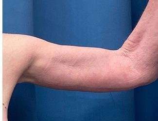 Arm Lift Before & After Patient #2473
