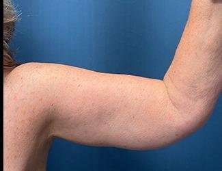 Arm Lift Before & After Patient #2482