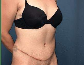 Tummy Tuck Before & After Patient #457