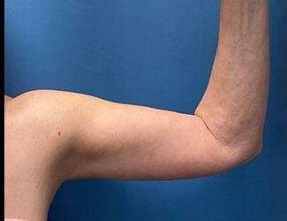 Arm Lift Before & After Patient #2491