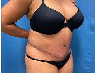 Tummy Tuck Before & After Patient #468
