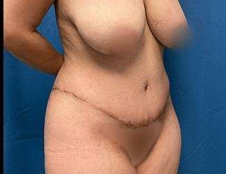 Tummy Tuck Before & After Patient #493