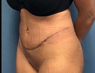 Tummy Tuck Before & After Patient #504