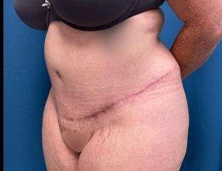 Tummy Tuck Before & After Patient #515