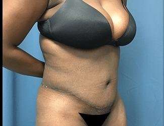 Tummy Tuck Before & After Patient #528
