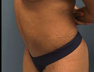 Tummy Tuck Before & After Patient #546