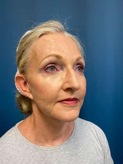 Submentoplasty Before & After Patient #654