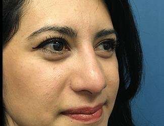 Rhinoplasty Before & After Patient #667