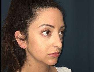 Rhinoplasty Before & After Patient #680