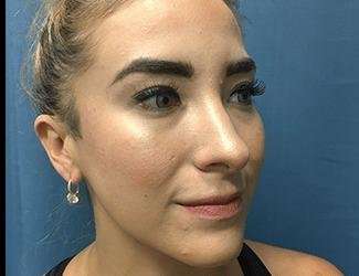 Rhinoplasty Before & After Patient #706