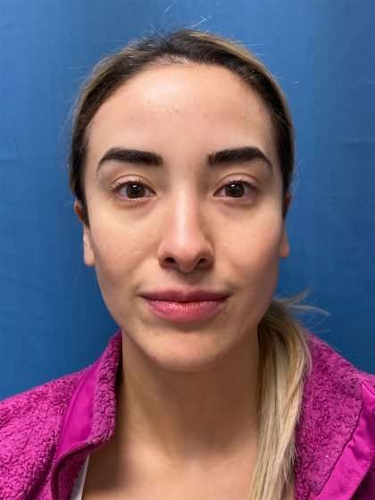Rhinoplasty Before & After Patient #715