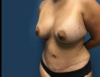 Mommy Makeover Before & After Patient #743