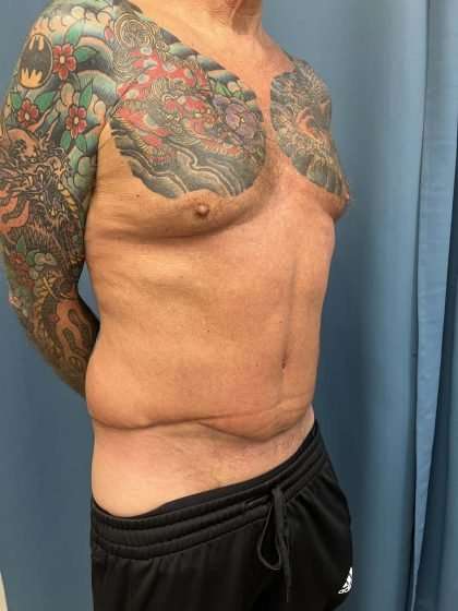 Tummy Tuck Before & After Patient #322