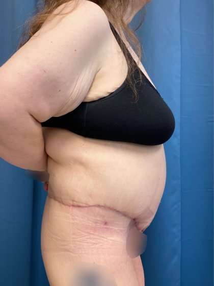 Lower Body Lift Before & After Patient #1021