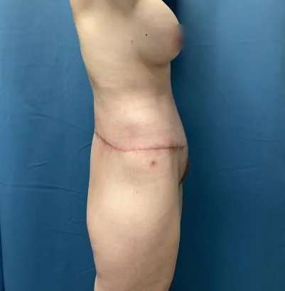 Lower Body Lift Before & After Patient #1034