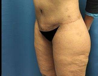 Lower Body Lift Before & After Patient #1047