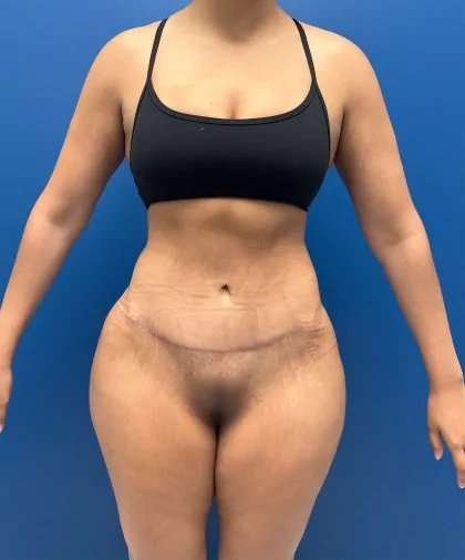 Lower Body Lift Before & After Patient #1081