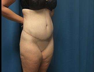 Lower Body Lift Before & After Patient #1114