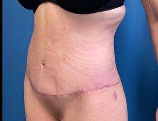 Lower Body Lift Before & After Patient #1127