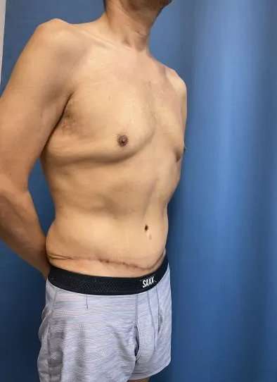 Tummy Tuck Before & After Patient #333