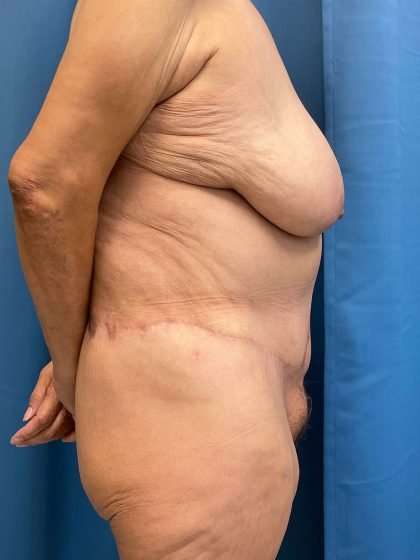 Lower Body Lift Before & After Patient #1141