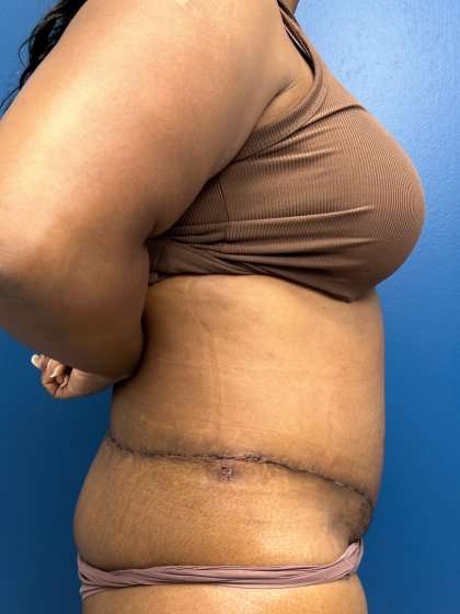 Lower Body Lift Before & After Patient #1154