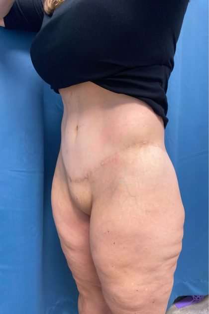 Lower Body Lift Before & After Patient #1174
