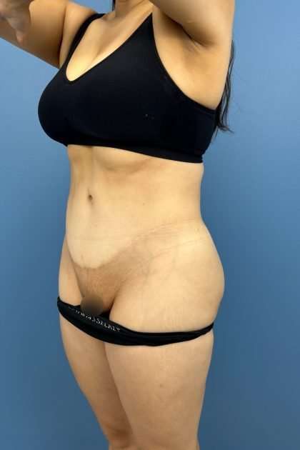 Lower Body Lift Before & After Patient #1213