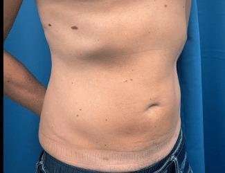 Liposuction Before & After Patient #1257