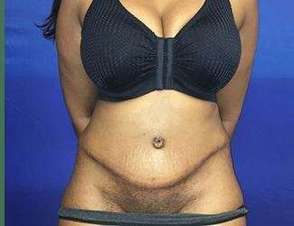 Tummy Tuck Before & After Patient #349