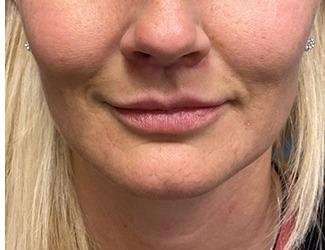 Lip Lift Before & After Patient #1289