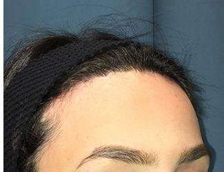 Forehead Reduction Before & After Patient #1364