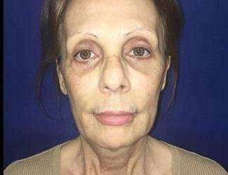 Facial Implants Before & After Patient #1392
