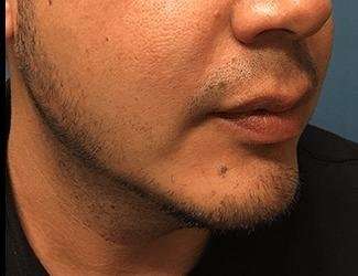 Facial Implants Before & After Patient #1403