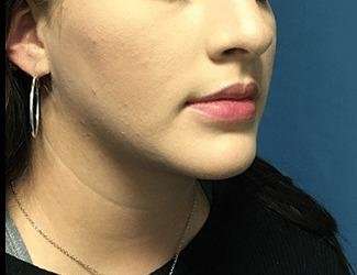 Facial Implants Before & After Patient #1416