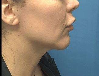 Facial Implants Before & After Patient #1464