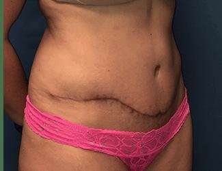 Tummy Tuck Before & After Patient #358