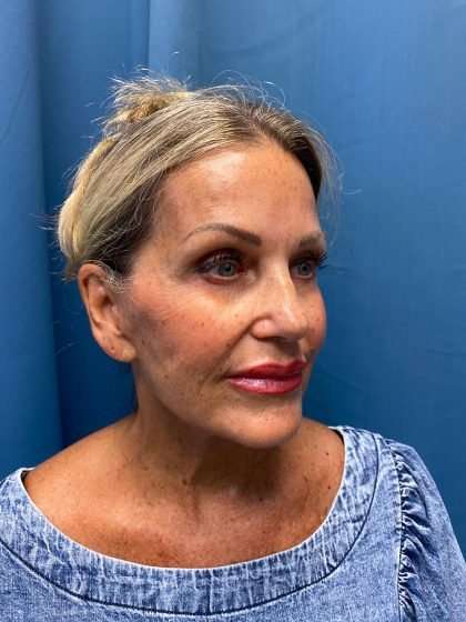 Facelift And Necklift Before & After Patient #1497