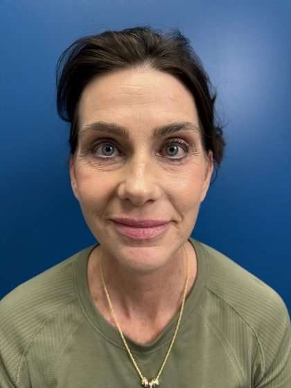 Facelift And Necklift Before & After Patient #1506