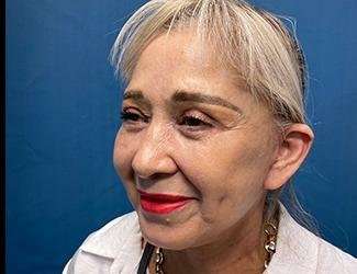 Facelift And Necklift Before & After Patient #1531
