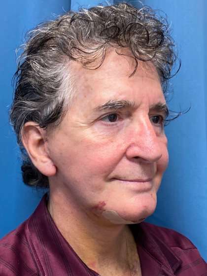 Facelift And Necklift Before & After Patient #1560