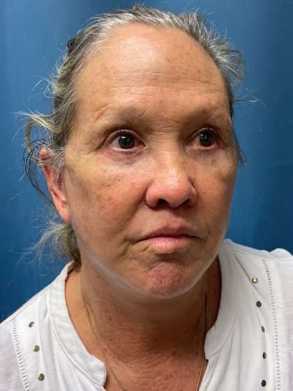 Facelift And Necklift Before & After Patient #1571