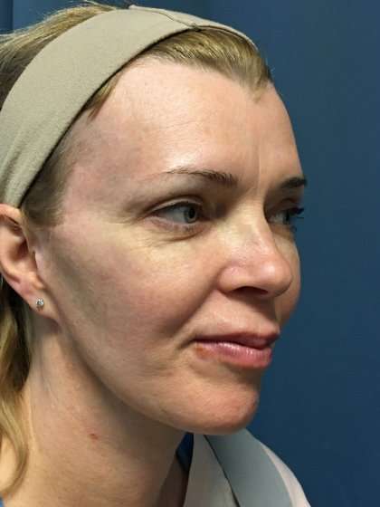 Facelift And Necklift Before & After Patient #1582