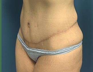 Tummy Tuck Before & After Patient #369