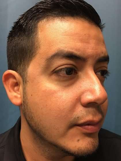 Chin Implant Before & After Patient #1604