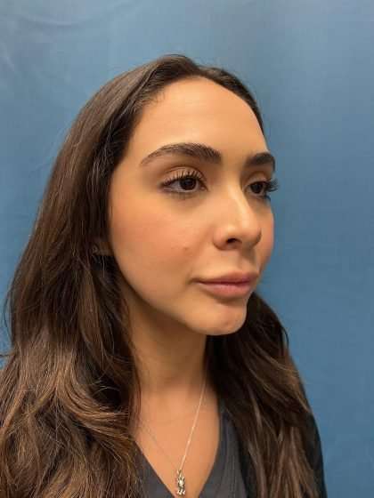 Chin Implant Before & After Patient #1622