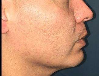 Buccal Fat Removal Before & After Patient #1656