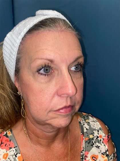 Brow Lift Before & After Patient #1694