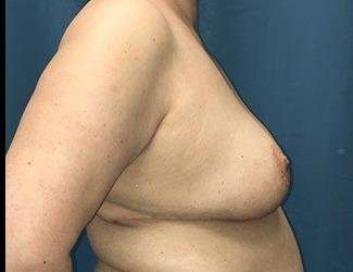 Breast Reduction Before & After Patient #1727